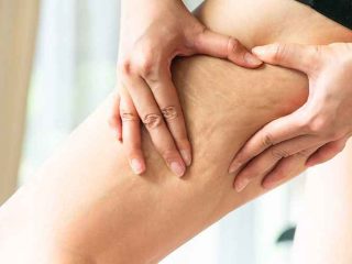 Cara Menghilangkan Strecth Mark Merah Dengan Vaseline Dalam Waktu Singkat