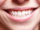 Efek Samping Memutihkan Gigi Dengan Jeruk Nipis dan Garam